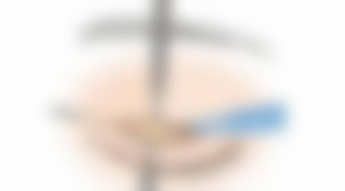打瘦脸针的注意事项