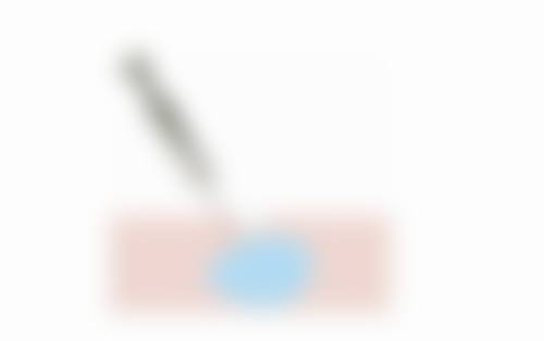 假体丰太阳穴是怎么弄的
