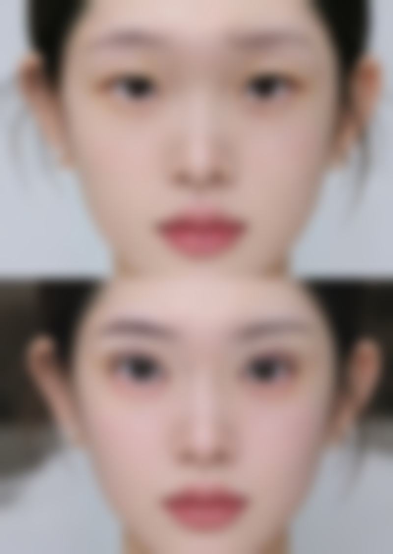 瘦脸针打几次能定型