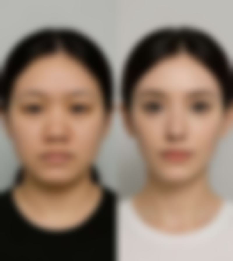 瘦脸针需要打几次才能定型
