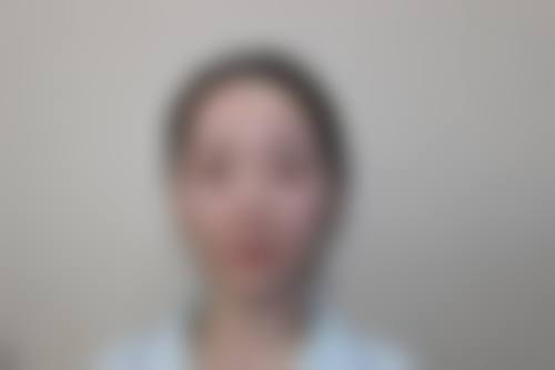 临床实例分享:达州仁美医学整形美容门诊部周院长的真实成效如何?