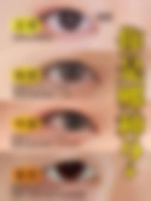 诊疗特色总结:谷城县人民医院眼科张元庆