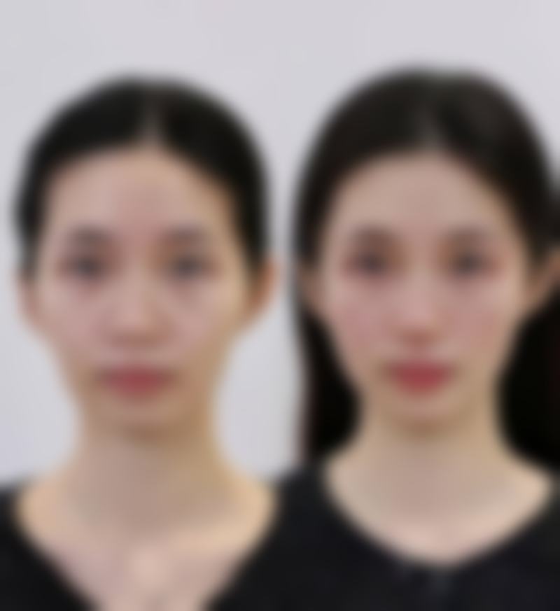 唇部调整的术前术后注意事项