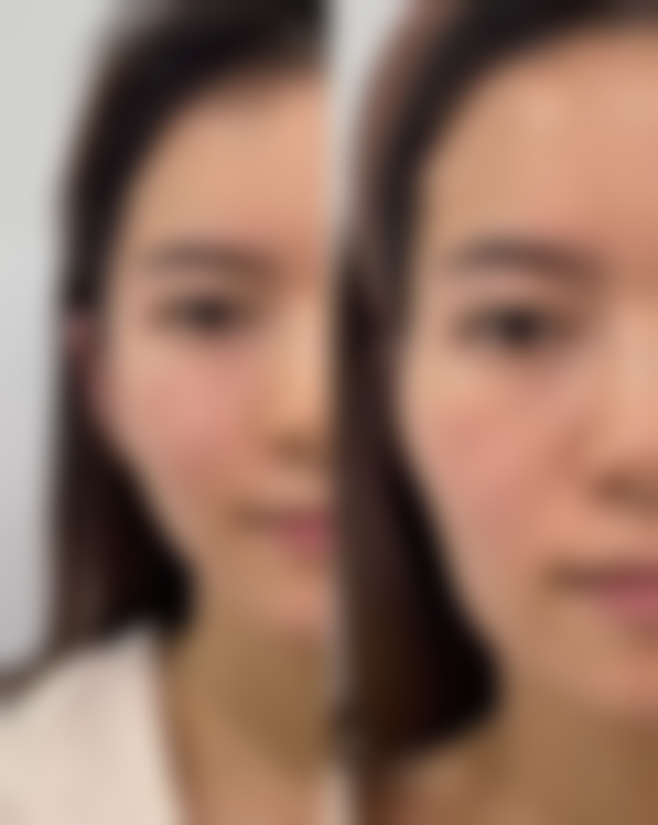 瘦脸针有什么副作用吗女性专属疑问解答