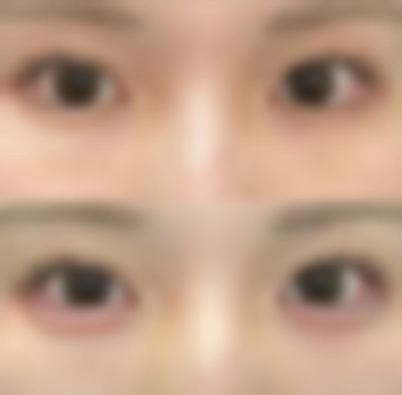 打瘦脸针多少钱一次?不同项目价格明细参考