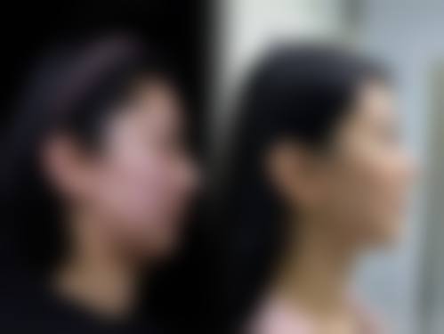 患者真实评价:济南艾魅丽医美美容医院杨效波
