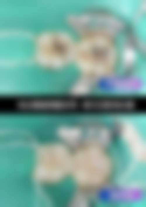 深圳冷伟琪口腔诊所超声波洁牙套餐18.38元