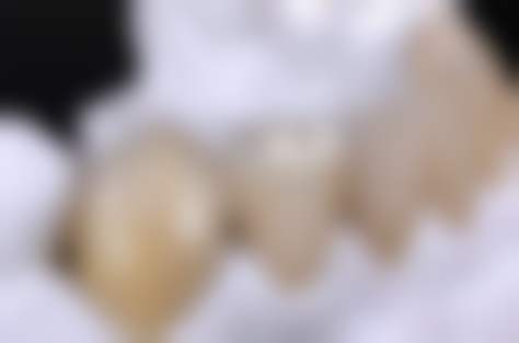 深度解析:时代天使隐形矫正正畸套餐限时优惠活动