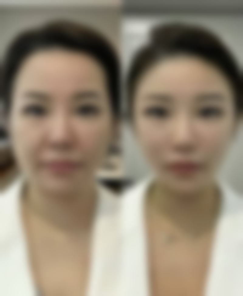 找韩国PROPOSE整形医院崔明烨做手术需要提前准备什么