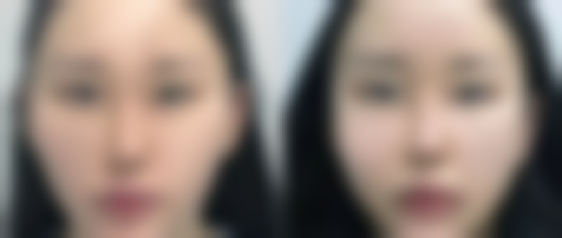 打完瘦脸下颌缘多久可以平躺?术后姿势注意事项