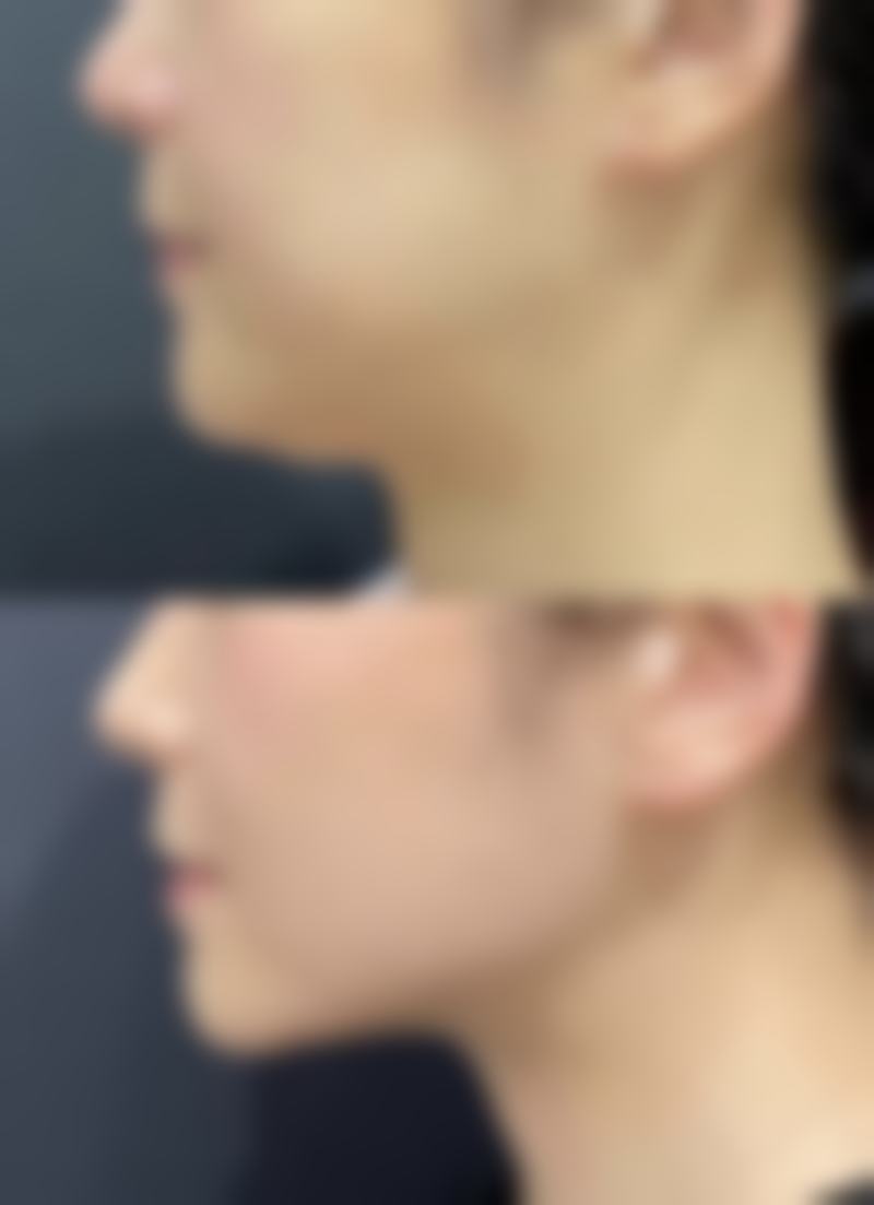 瘦脸针打完多久能修复之前的样子图片可以参考吗?怎么判断自己的修复进度?